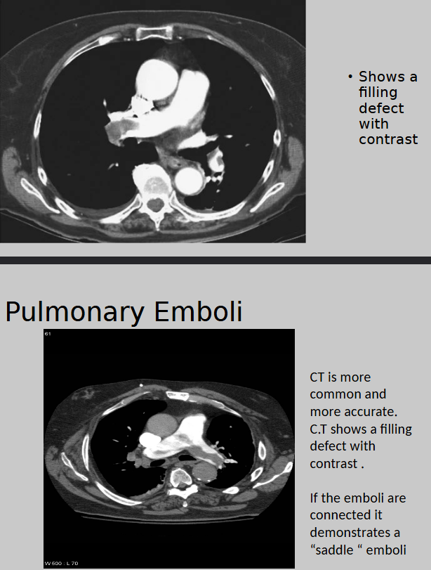 <p>CT (most common and more accurate) shows filling defect, NUCMED ventilation study shows perfusion defect<br><br>serial CXR rarely to never done but show enlargement of affected vessels<br><br>[larger white area = pulmonary trunk leading to the right and left pulmonary arteries]</p>