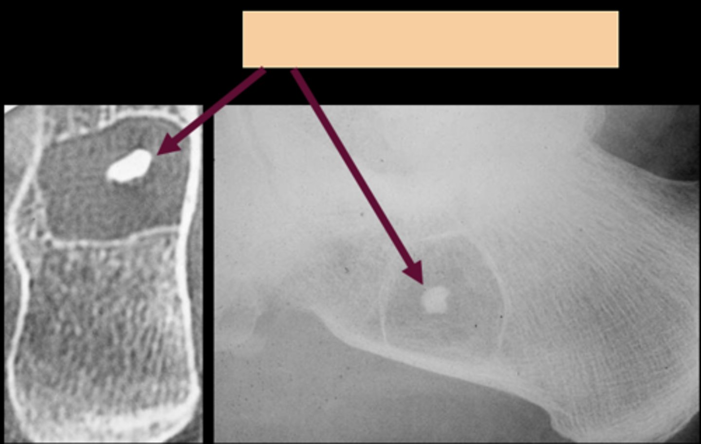 <p>ID sign of intraosseous lipoma</p>