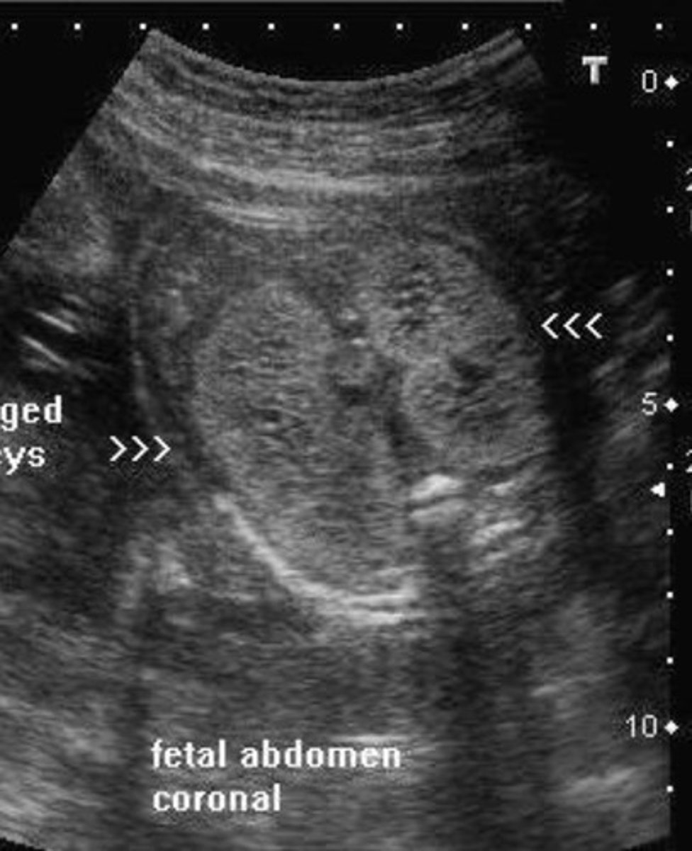 <p>Bilateral micro cysts</p><p>Bilateral enlarged, echogenic kidneys</p><p>Empty bladder</p>