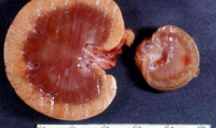 <p>failure of organ development</p>