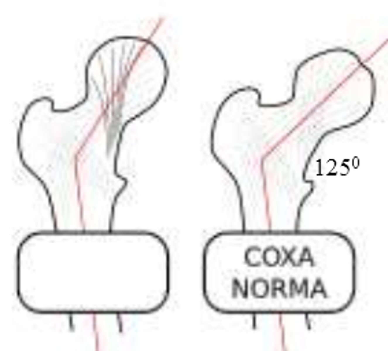 <p>development of femur with angle of inclination GREATER than expected</p><p>*involves femoral head/neck and shaft</p>