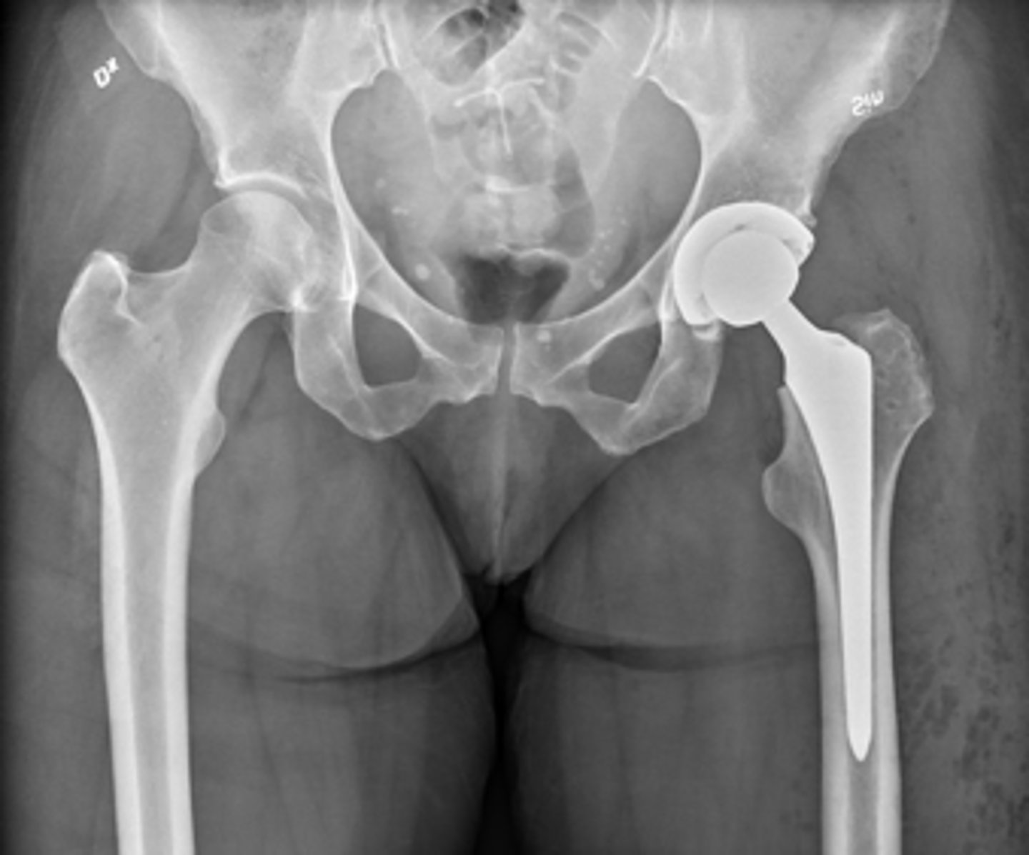 <p>Several different surgical interventions. Procedures:</p><p>•Total hip arthroplasty</p><p>•Decompression +/- bone grafting</p><p>•Rotational osteotomy</p><p>•Total hip resurfacing</p>