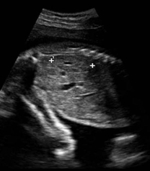 <p>what is being measured</p><p>a) right kidney length</p><p>b) left kidney length</p><p>c) liver length</p><p>d) spleen length</p>