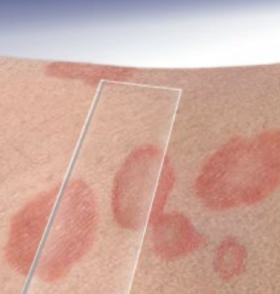 <p>what type of lesion is depicted and what area does it cover</p>