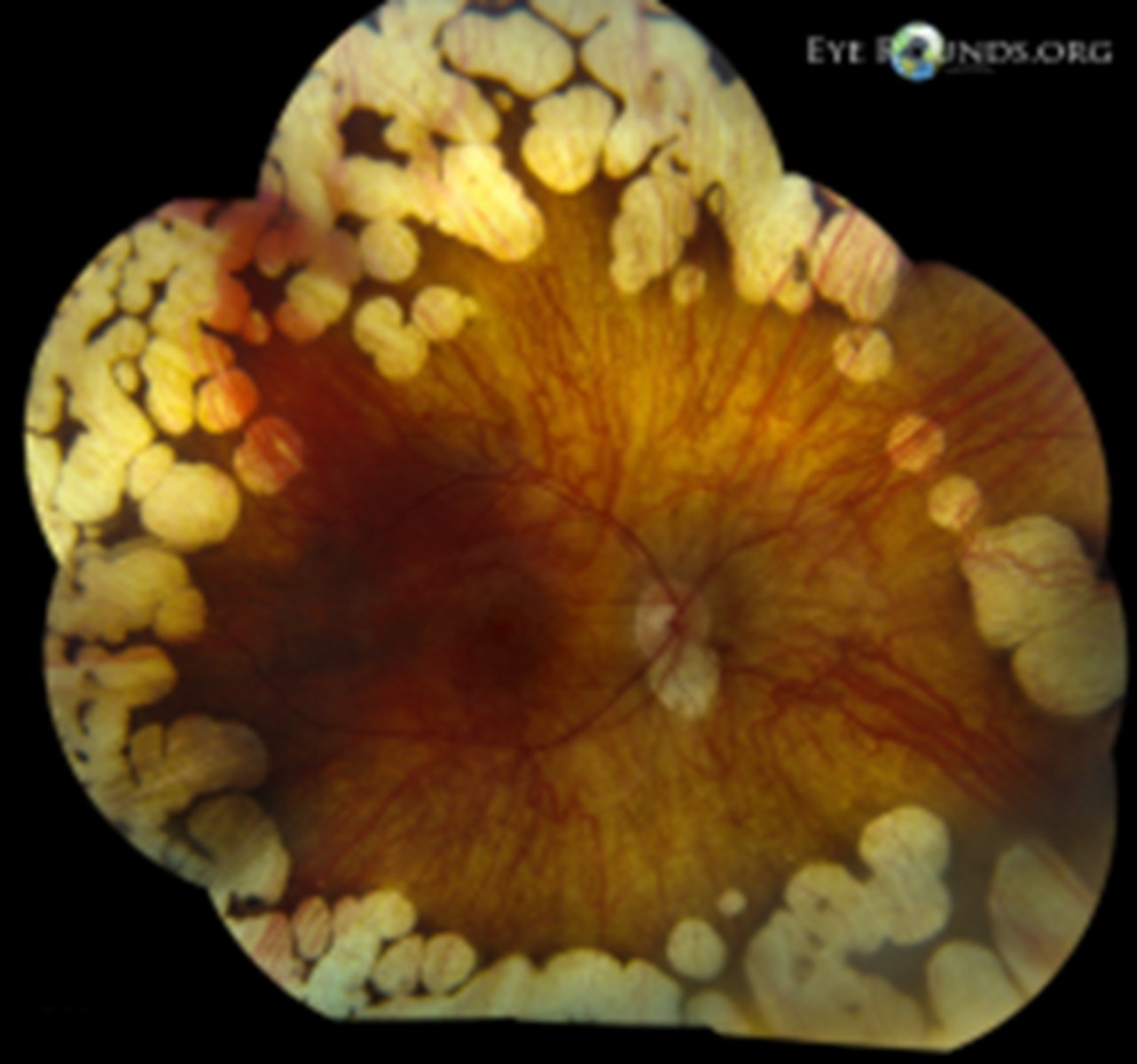 <p>bilateral chorioretinal degeneration in the mid-far periphery = patchy, sharply demarcated circles of atrophy with hyperpigmented margins</p><p>early CATs</p><p>myopia</p>