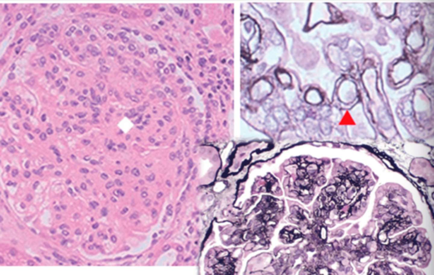 <p>-subendothelial electron dense deposits</p><p>-duplication of basement membrane</p><p>-accentuated lobular architecture</p><p>-mesangial cell proliferation (increased cellularity)</p><p>-increased mesangial matrix</p><p>-BM thickening with splitting/ duplication (double contour, "tram tracking")</p><p>-influx of WBCs</p>