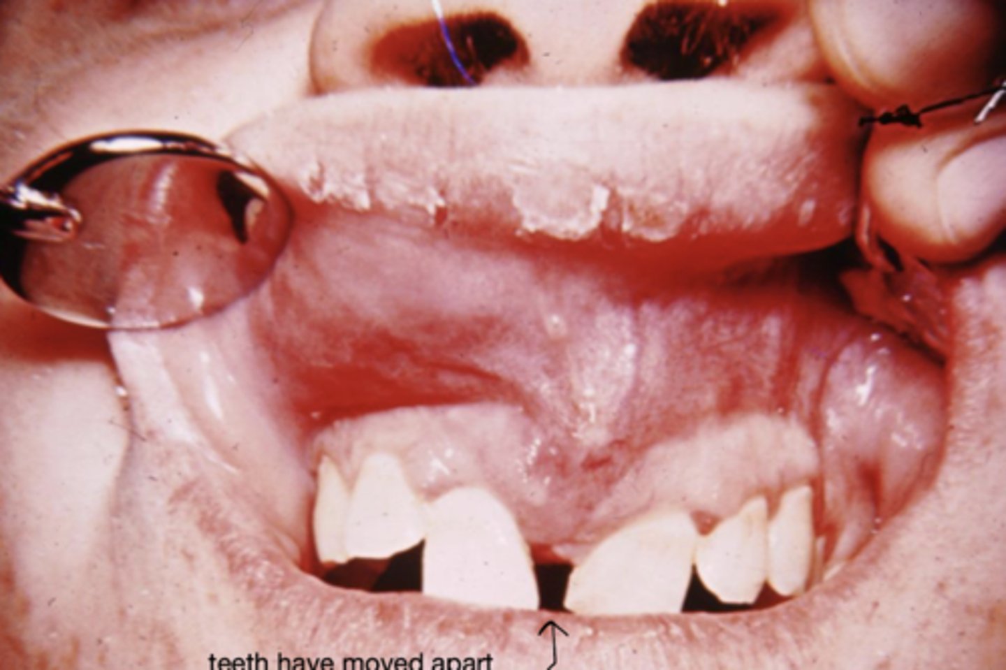 <p>= Malignant tumor of cartilage</p><p>- Midline of maxilla (embryologic leftover cartilage)</p>