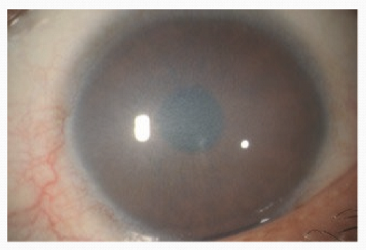 <p>A rare disorder affecting the corneal endothelium, causing clouding and vision impairment due to the dysfunctional endothelial cells failing to remove excess fluid from the cornea</p>