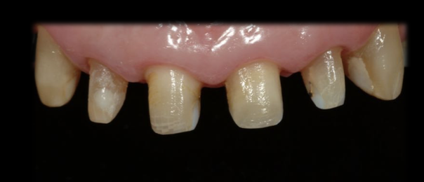 <p>Indications for Complete Ceramic Crown</p>