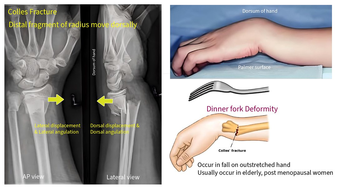 <p>colles fracture</p><ul><li><p>common extra-articular fracture</p><ul><li><p>bone break that does <em>not</em> involve the articular surface (the surface of the bone that forms part of a joint)</p></li></ul></li><li><p>occurs as a result of a fall on an outstretched hand</p></li><li><p><strong>posterior displacement</strong></p></li><li><p><strong>medial angulation</strong> of the distal radius (tilting of the distal fragment of the radius bone toward the ulna)</p></li></ul><p></p>