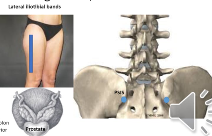 <p>anterior point: lateral iliotibial bands<br>posterior point: PSIS</p>