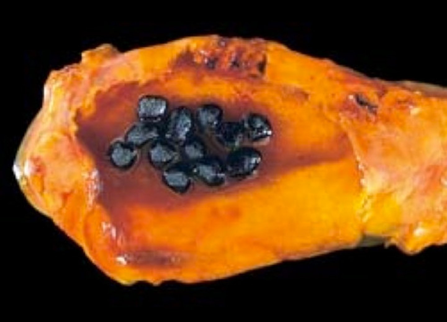 <p>gallstone type associated with chronic hemolysis</p>
