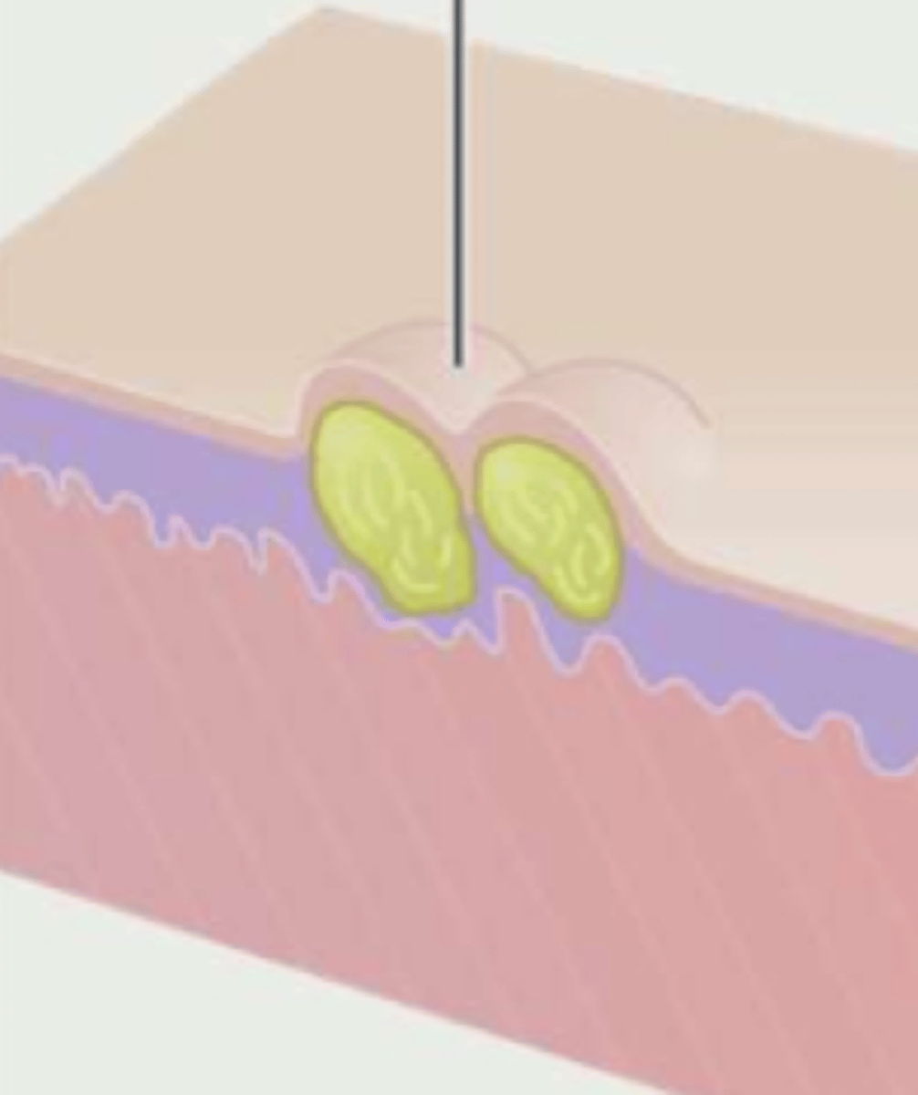 <p>¿lesión?</p><p>¿primaria o secundaria?</p>