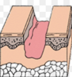 wound ends can't communicate, scab has to form, scar tissue is left; includes acute inflammation then reconstructing phase, then maturation phase
