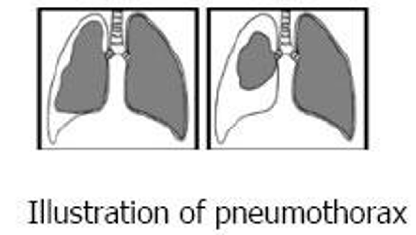 <p>Pneumothorax.</p>