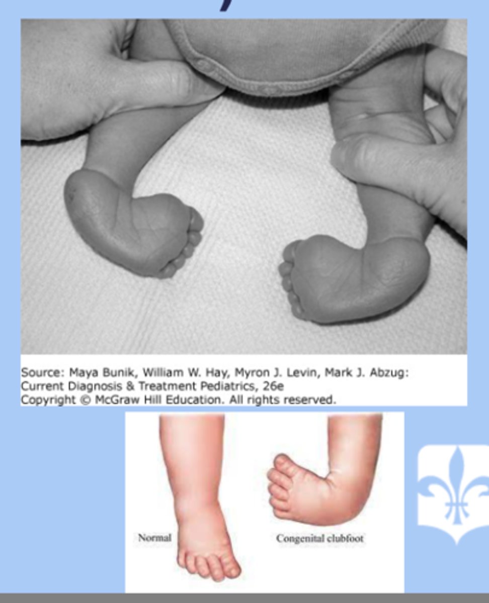 <p>-idiopathic most common </p><p>-check spine</p><p>-dx: equinus (plantar flexion), varus (heel inversion), adductus (forefoot medial deviation) </p><p>-tx: ponseti technique, start immediately after birth </p>