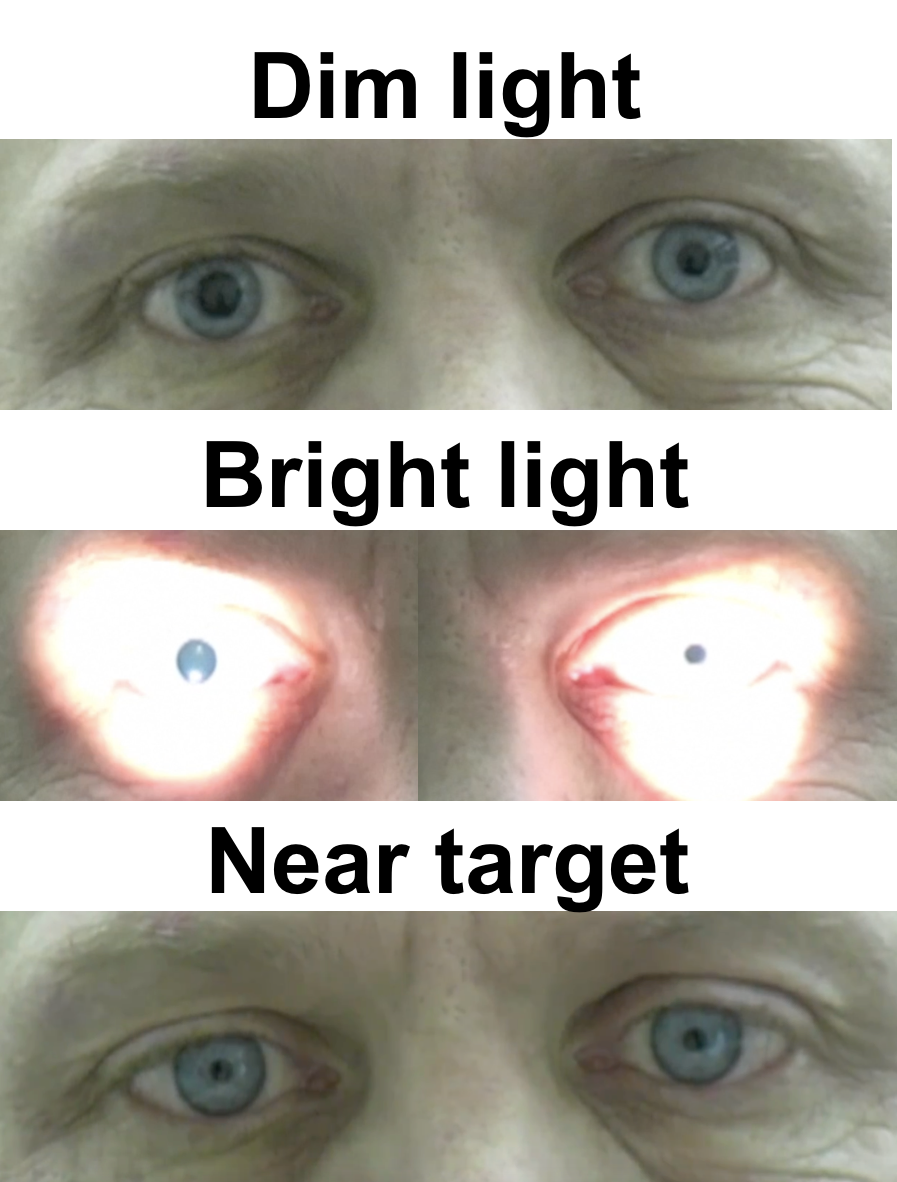 <p>PP: large/dilated pupil+slowed constriction</p><p>E: parasympathetic damage</p><p>CM: slow accommodation→blurry vision</p><p>PE:<br>light reaction→severely reduced/slowed/absent+slow/tonic near reaction constriction present</p>