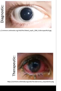 <p>diagnostic&nbsp;</p><p>therapeutics: bacterial conjunctivitus , blood vessels dilate&nbsp;</p><p>most px will be taking medications which could cause issues for the eye</p>
