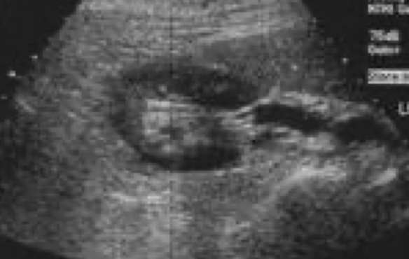 <p>Is this the right or left kidney? trans or long? upper, mid or lower pole</p>