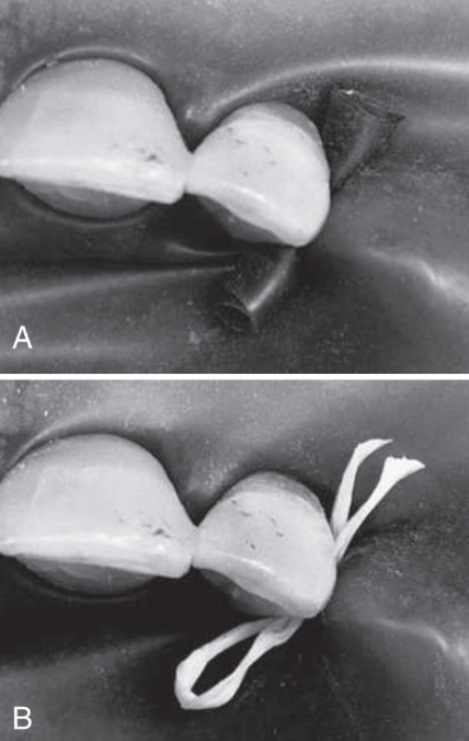 <p>What do you use to anchor the last tooth?</p>
