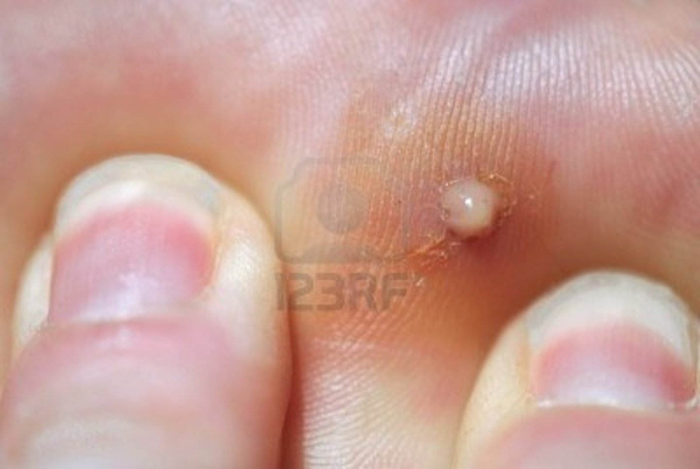 <p>thick, yellowish liquid that forms in and comes from an infected cut or injury in the body: mủ</p>