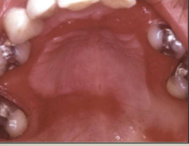 <p>candidiasis causing localized erethema in denture areas</p>