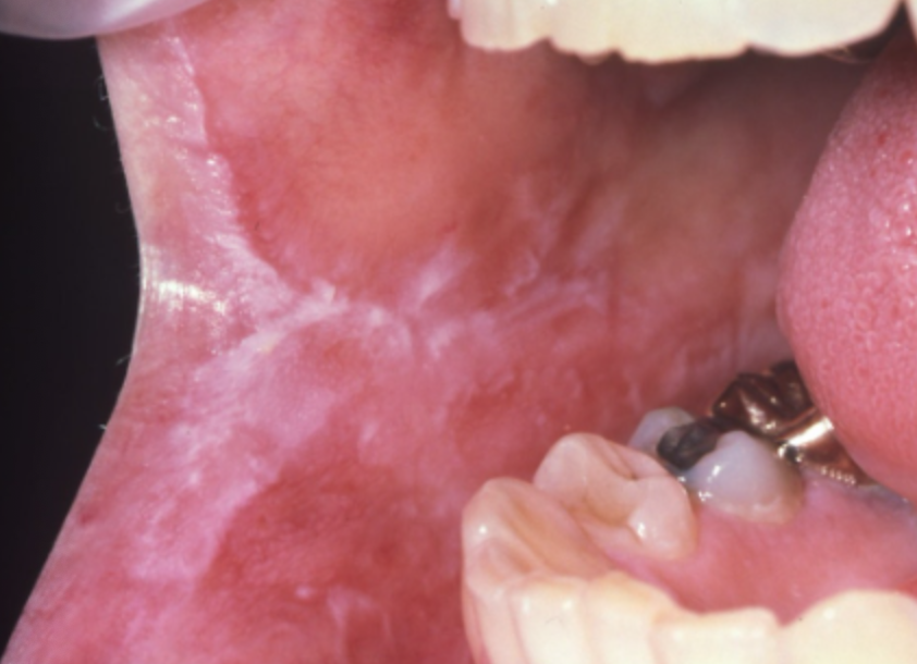 <p>2b. What feature supports a cinnamon-induced lichenoid mucositis?</p>