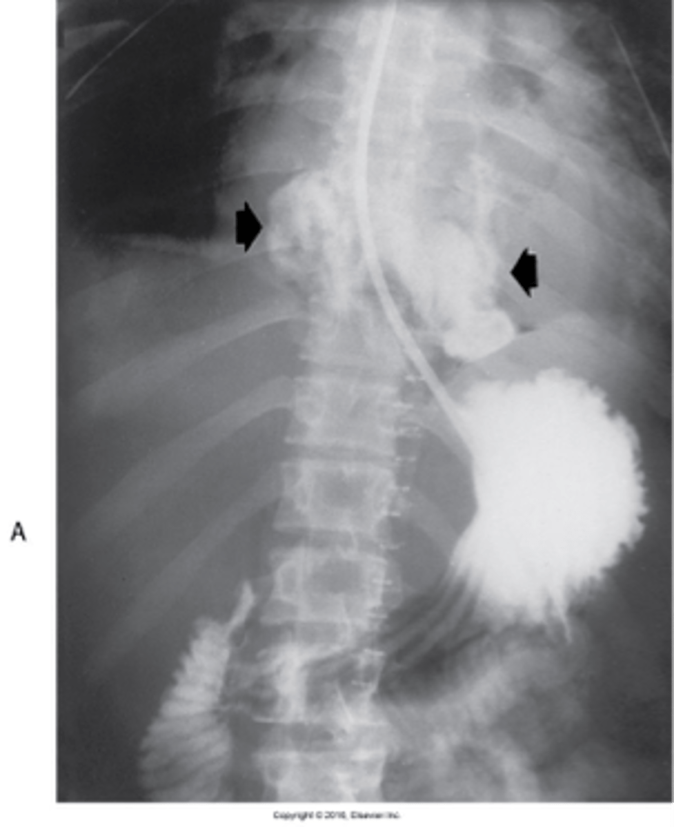 <p>What are complications of Perforation of the Esophagus?</p>