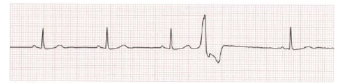 <p>These are shown when there is a wide QRS complex that is not proceeded by a P wave.</p>