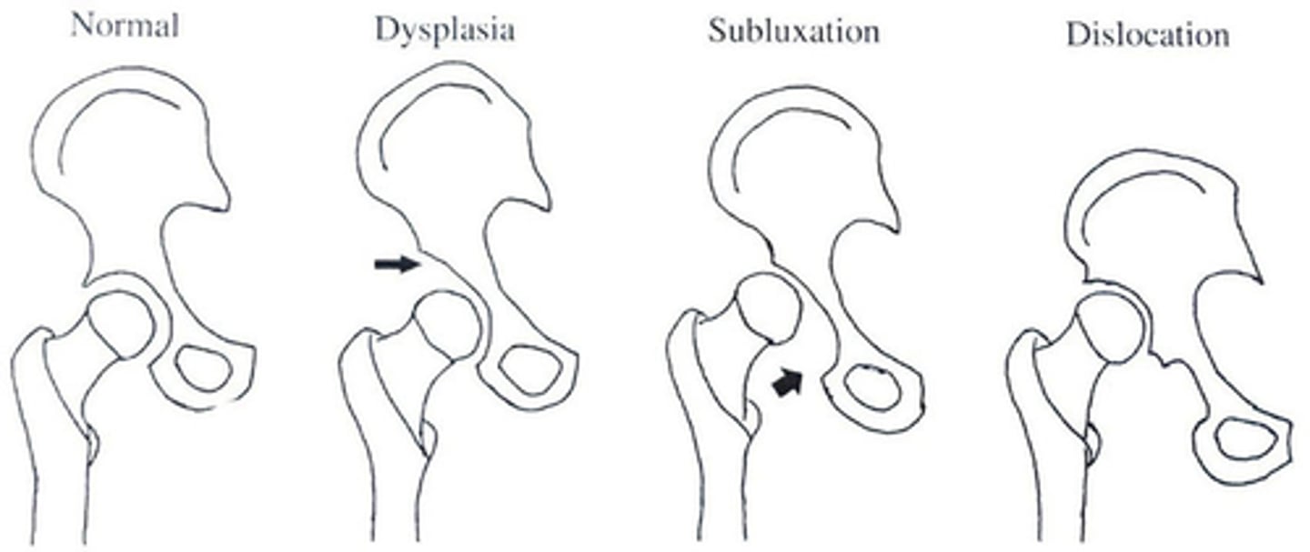 <p>-Mildest form of DDH</p><p>-Delay in acetabular development (The acetabular roof is shallow and oblique)</p>