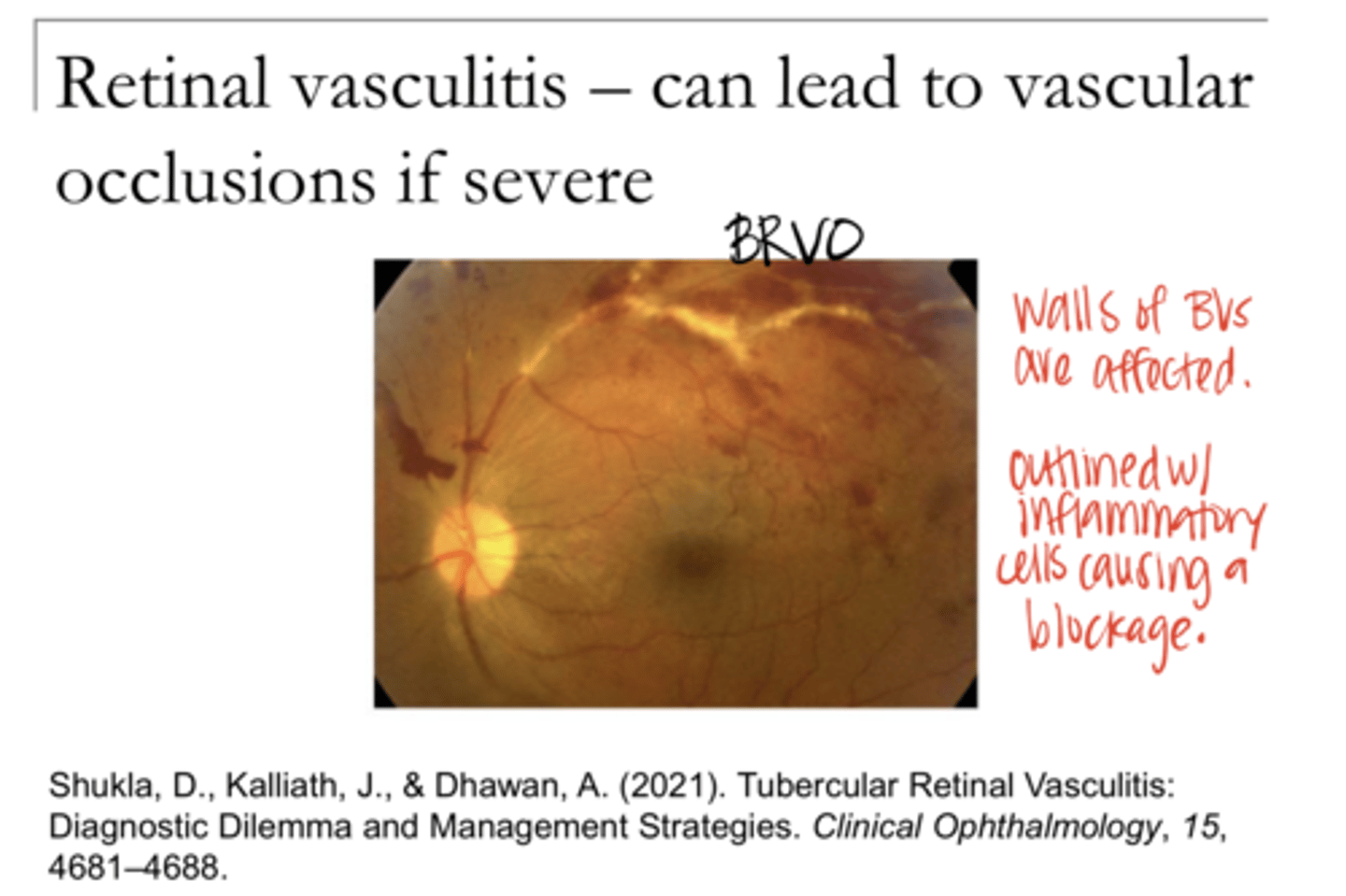 <p>Retinal Vasculitis (Pic)</p>