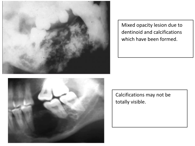 <p>Radiolucency with Speckled Calcifications</p><p>Calcifications increase with Age</p><p>Much bigger than AOTs </p><p>Doesn’t have dentigerous relationship</p>