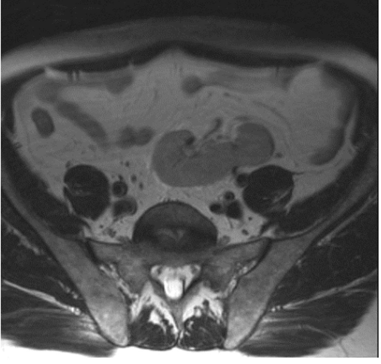 <p>Un riñón ubicado en la pelvis en lugar del retroperitoneo.</p>