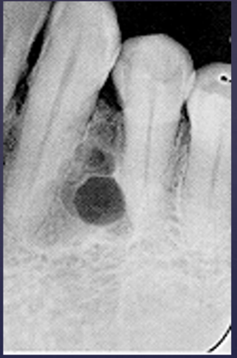 <p>What would be a differential diagnosis for this lesion?</p>