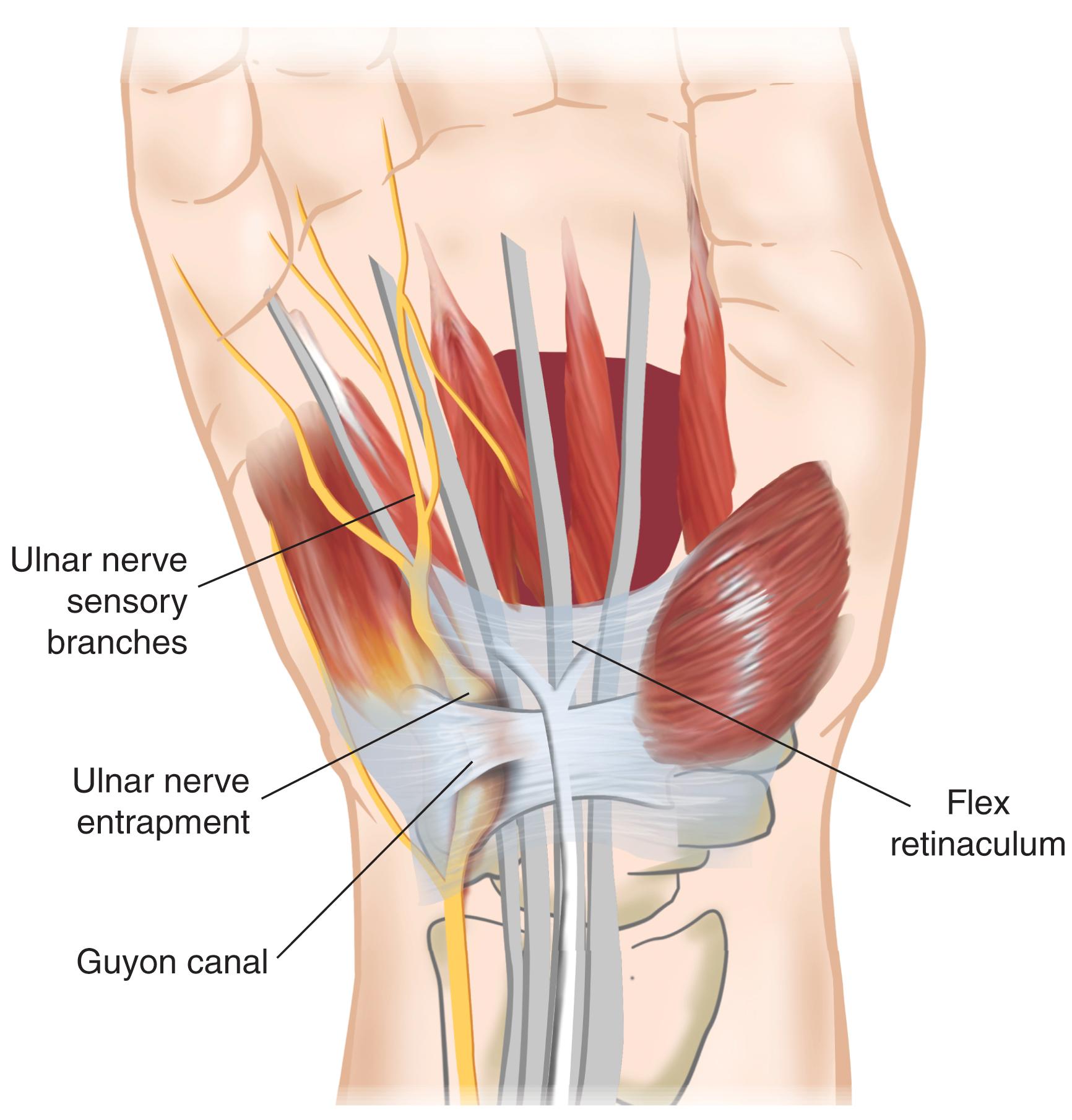 <p>A fibro-osseous passageway in the wrist that houses the ulnar nerve and artery as they enter the hand</p>