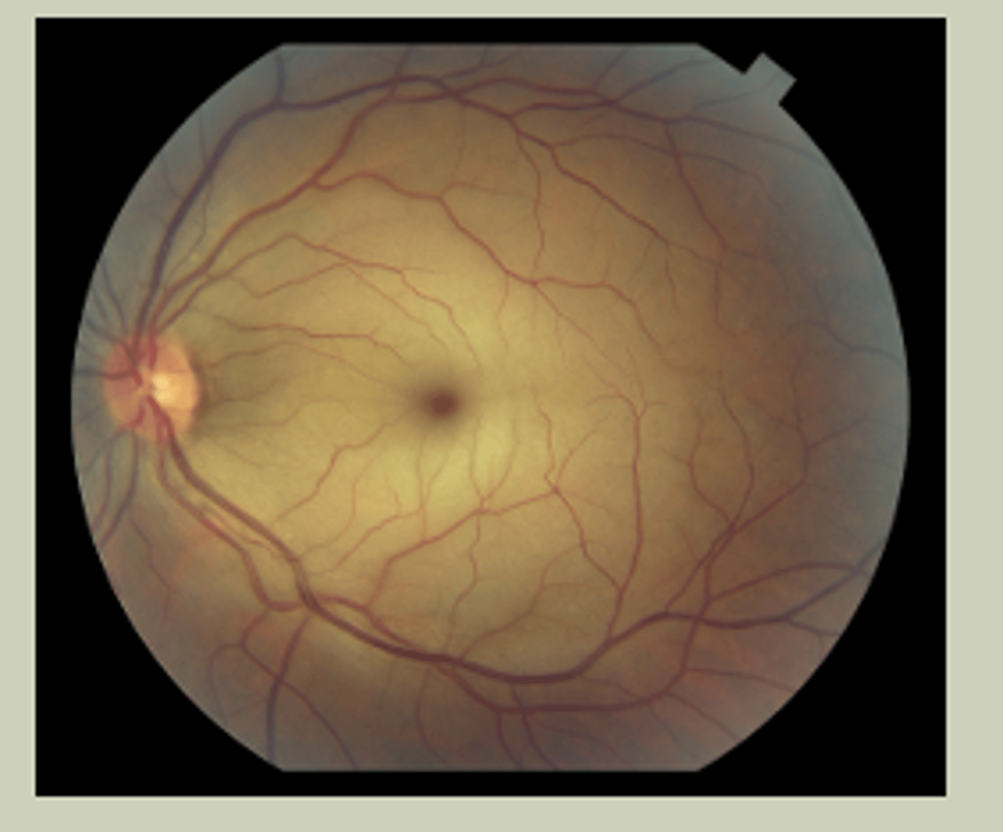 <p>-Sudden, painless LOV unilaterally</p><p>-Hx of HTN</p><p>-Associated with Giant cell arteritis</p><p>-Retinal Whitening with cherry red spot (macula)</p><p>-TX: EMERGENT referral to ECP/ED</p>