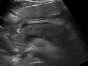 <p>Initial= normal</p><p>If findings= hypoechoic, enlarged, phlegmon (perioancreatic fluid), pseudocyst (most common in lesser sac), possible ductal dilation</p>