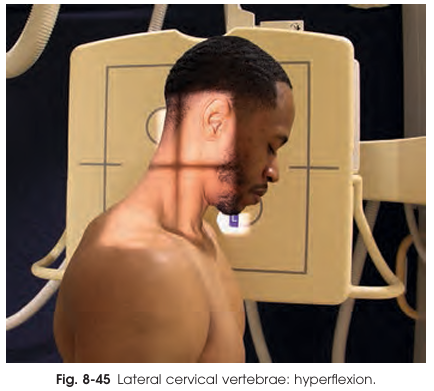 <ul><li><p>Patient drops head forward, chin toward the chest</p></li><li><p>Spinous processes appear elevated and widely separated</p></li></ul><p></p>