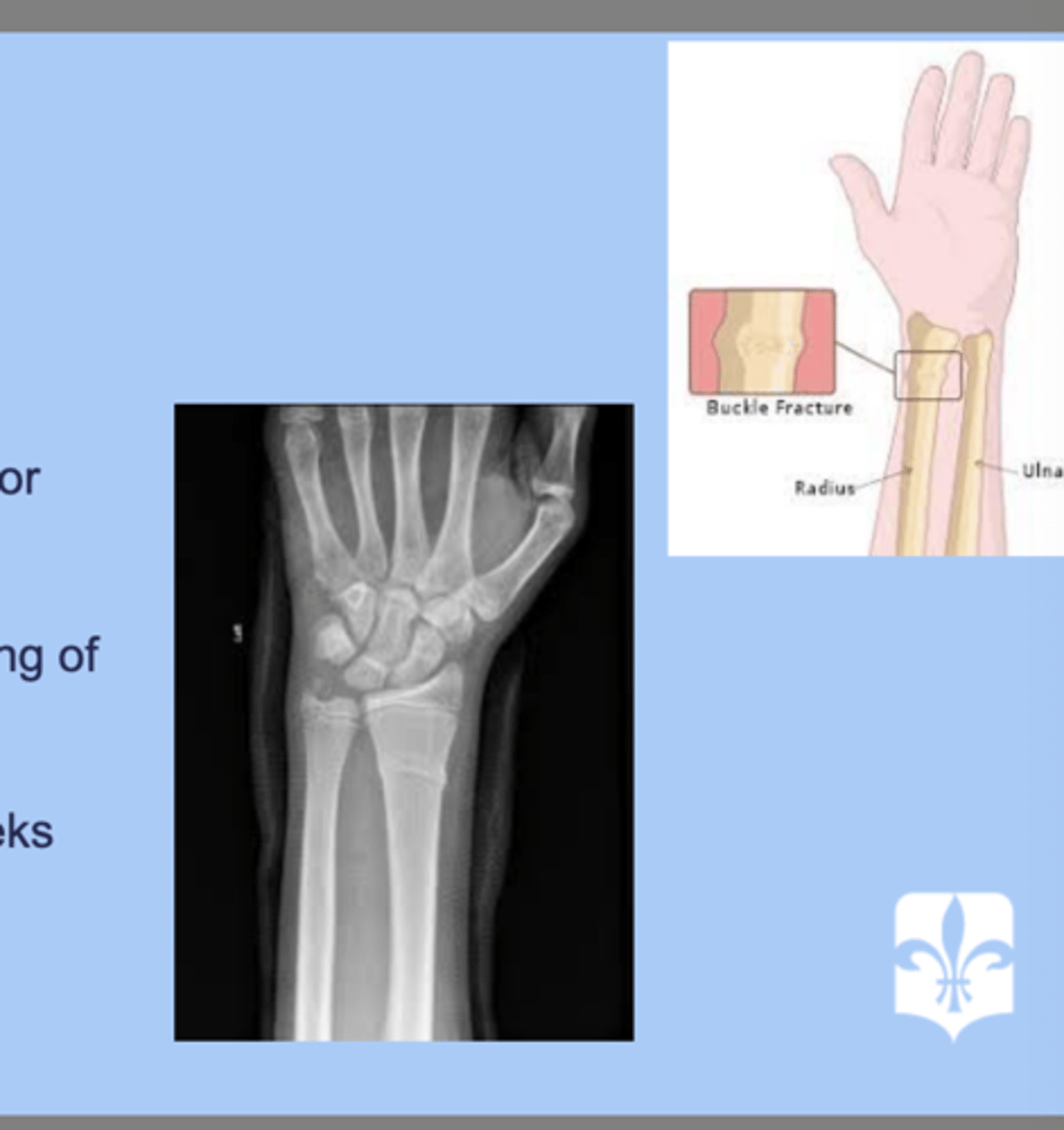<p>-buckling of the cortex due to compression of the bone </p><p>-distal radius or ulna </p><p>-dx: XR= bulking of bone </p><p>-tx: alignment with cast for 3 weeks </p>