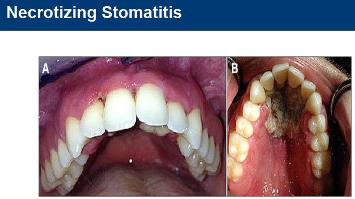 <ul><li><p>Treatment for NG and NP + dealing with necrosis progression to deeper tissues beyond mucogingival line </p></li><li><p>Refer immediately to oral pathologist, oral maxillofacial surgeon and physician (gp) </p></li></ul><p></p>