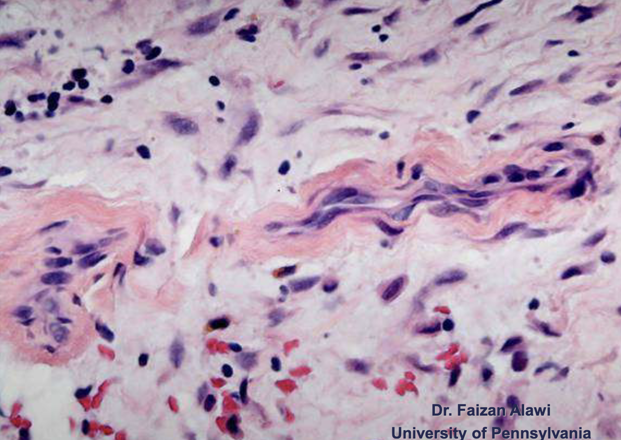 <p>eosinophilic cuffing (pink areas around purple), deposits around periphery of blood vessels </p>