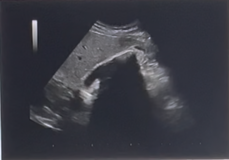 <p>What artifact is demonstrated on the US image posterior to the gallbladder?</p><p>a. comet-tail artifact<br>b. clean posterior shadowing<br>c. dirty posterior shadowing <br>d. posterior enhancement</p>