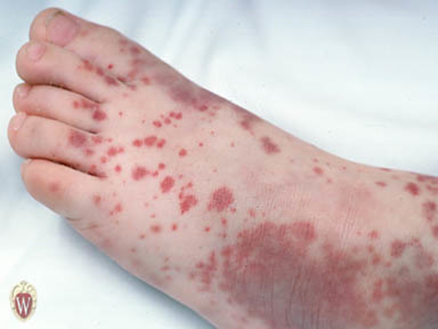 <p>______________ Etiology:</p><p>•Bleeding under the skin</p>
