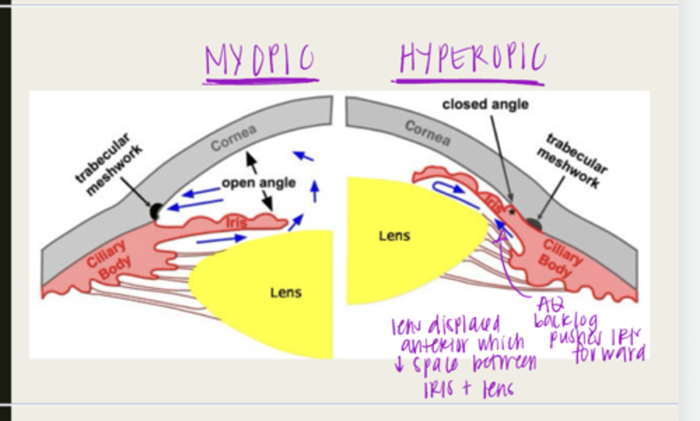 <p>What are the risk factors for primary angle closure glaucoma?</p>