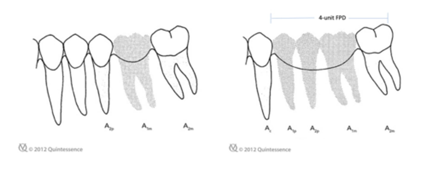 <p>The prosthodontic principle illustrated in these figures is primarily related to _________</p>