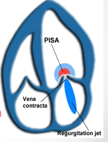 <p>jets : central</p><p>orifice : circular&nbsp;</p><p>(holosystolic MR)</p>