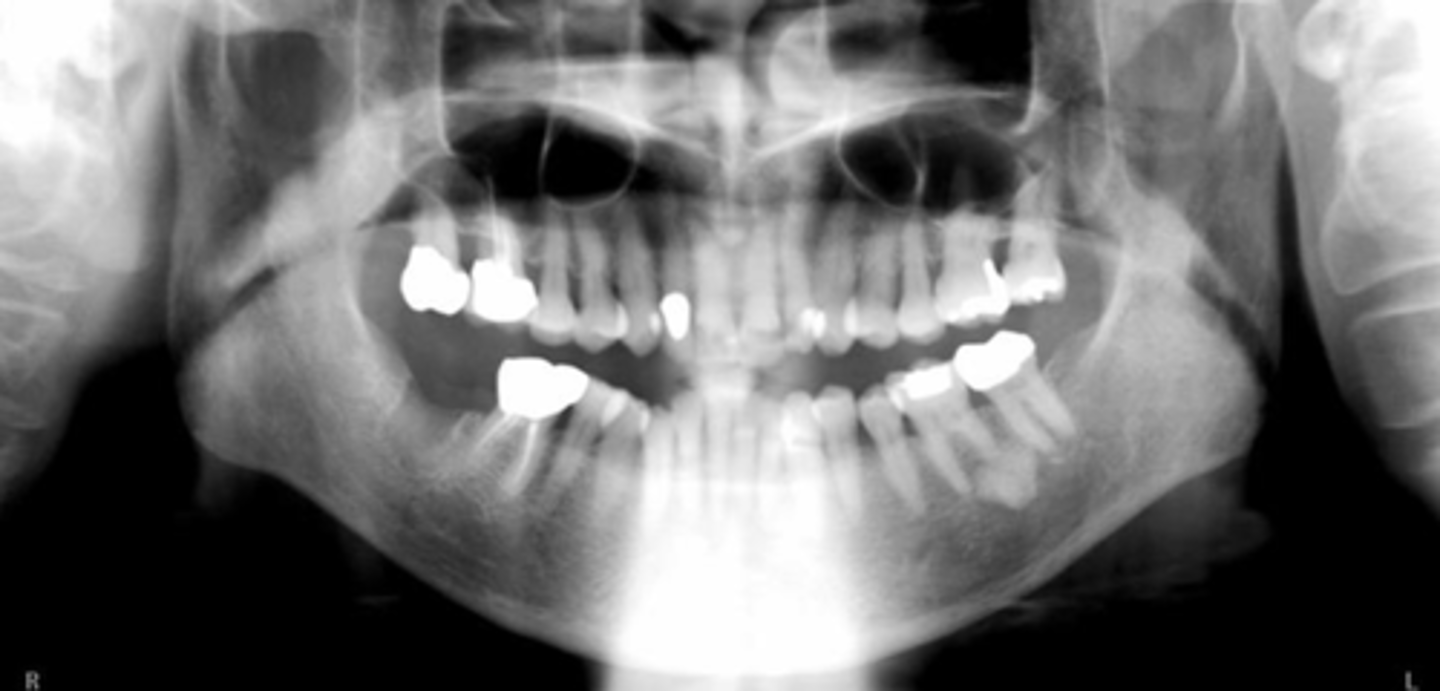 <p>If the pan image appeared too smiley, the patient's chin was too far ___ (image is just a placeholder and not necessarily related to this question)</p><p>A) up</p><p>B) down</p>