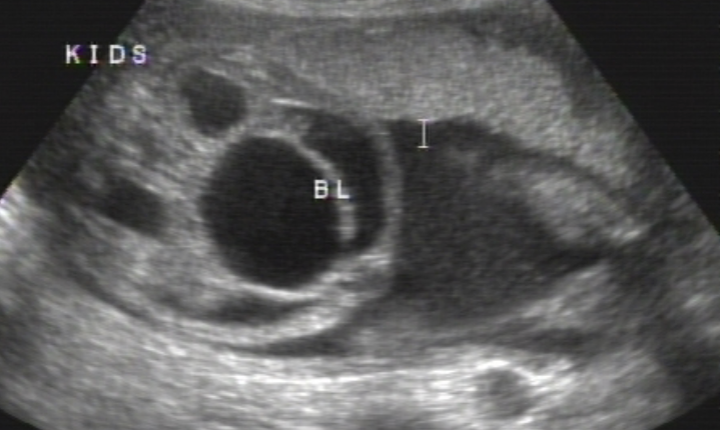 <ul><li><p>Occurs due to blockage at some level in urinary system</p></li><li><p>urine backs up into kidney</p></li></ul><p></p>