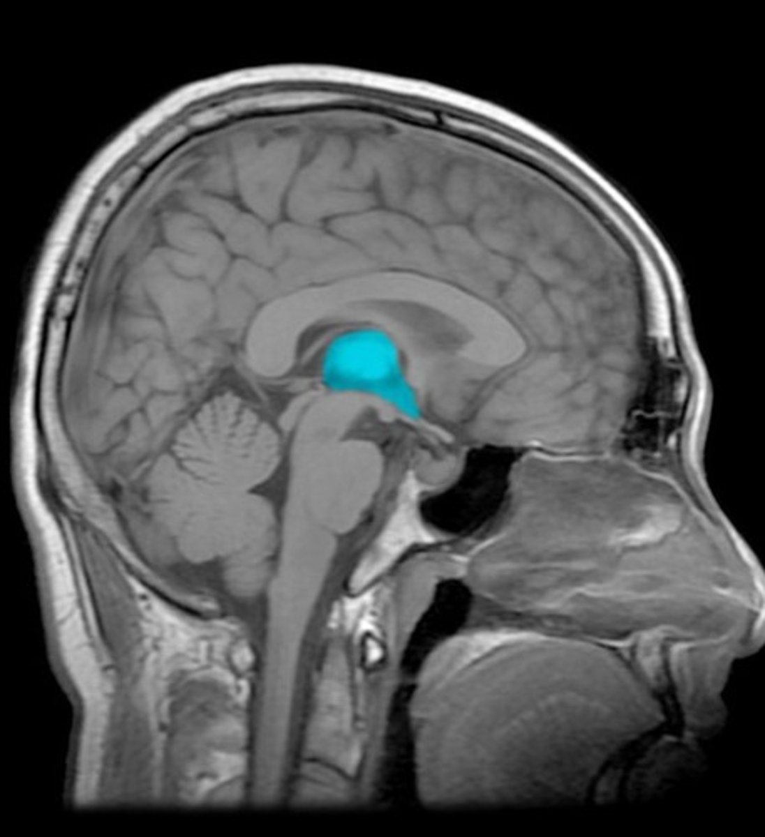 <p>slit-like cavity between left and right halves of diencephalon and continues with cerebral aqueduct to connect with 4th ventricle</p>