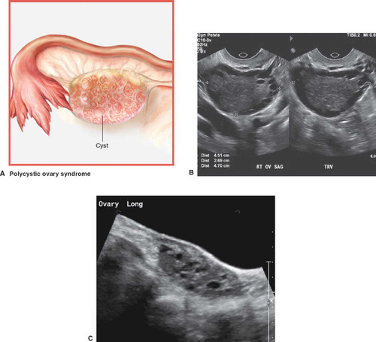 <p>- many small cysts along periphery of ovary (string of pearls)</p><p>- many small cysts throughout ovary</p><p>- ovarian enlargement</p><p>- increased stromal echogenicity</p>